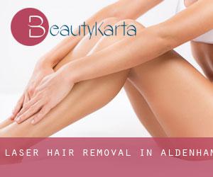 Laser Hair removal in Aldenham