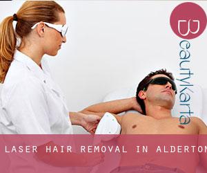 Laser Hair removal in Alderton