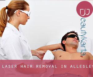 Laser Hair removal in Allesley