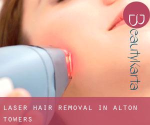 Laser Hair removal in Alton Towers