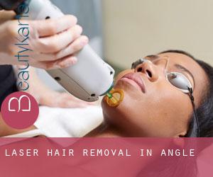 Laser Hair removal in Angle