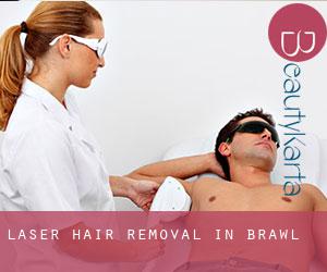 Laser Hair removal in Brawl