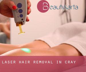 Laser Hair removal in Cray Laser Hair removal in Cray