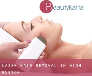 Laser Hair removal in High Buston