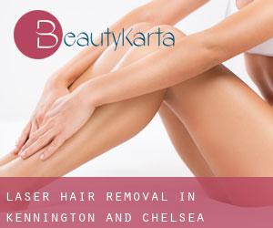 Laser Hair removal in Kennington and Chelsea