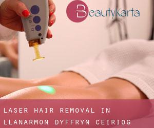 Laser Hair removal in Llanarmon Dyffryn-Ceiriog